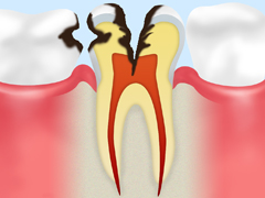 歯が溶かされる（脱灰）