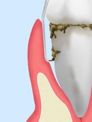 中等度歯周病～ルートプレーニング～