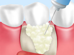 重度歯周病～歯周外科手術～