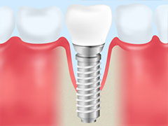 インプラント治療と歯周病