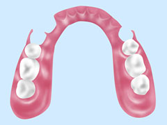 見た目がいい部分入れ歯～ノンクラスプデンチャー～