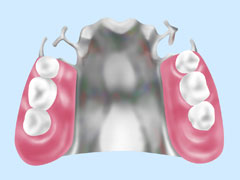 薄くて軽い、頑丈な入れ歯～金属床～