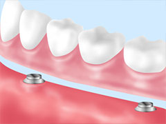 磁石で固定する外れにくい入れ歯～磁性アタッチメント義歯～