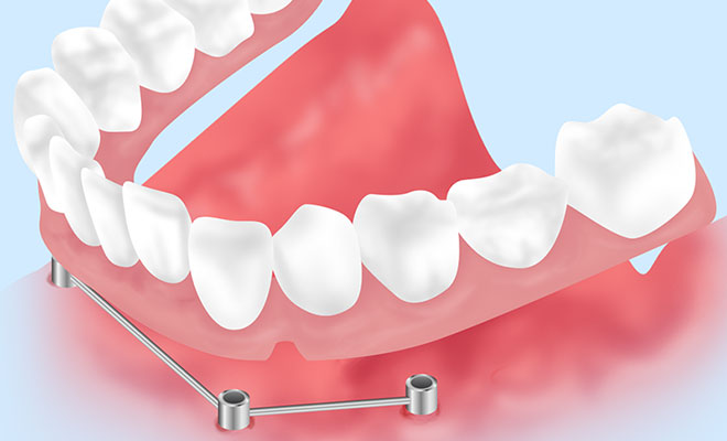 義歯（入れ歯）を固定する～インプラントオーバーデンチャー～