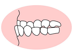 反対咬合(はんたいこうごう)