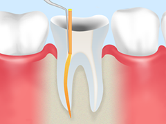 根管治療