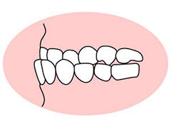 反対咬合(はんたいこうごう)