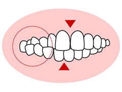 交叉咬合(こうさこうごう)