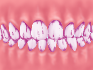 プラーク（歯石）の染め出し
